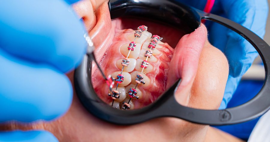 Braces cost $3,680 to $9,650 in 2026