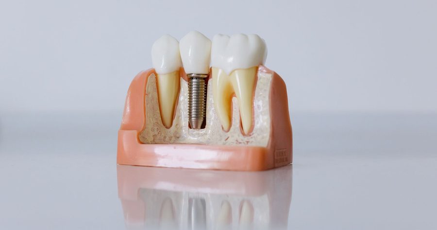 A single dental implant costs $2,005 to $5,255 in 2026