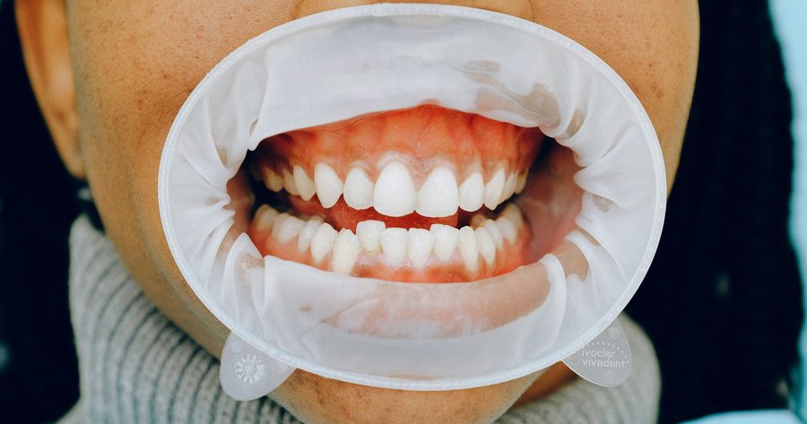 A gum graft costs $600 to $1,570 per site in 2026