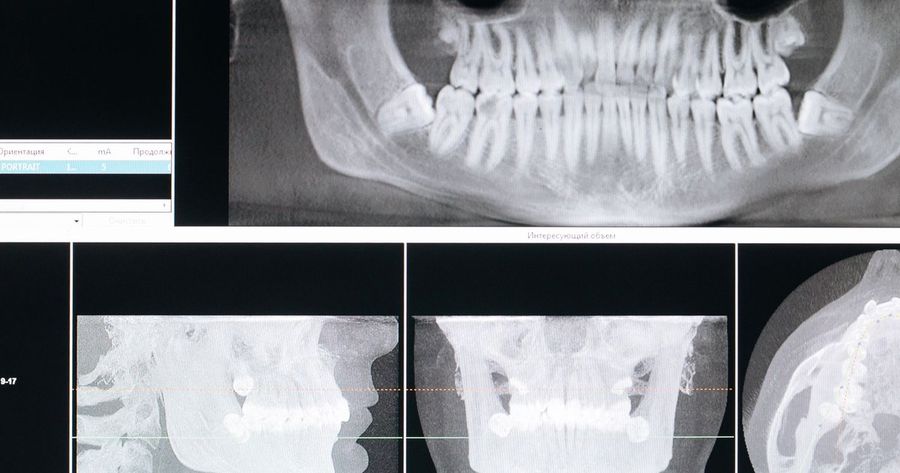 Jaw surgery costs about $20,000 to $40,000 without insurance