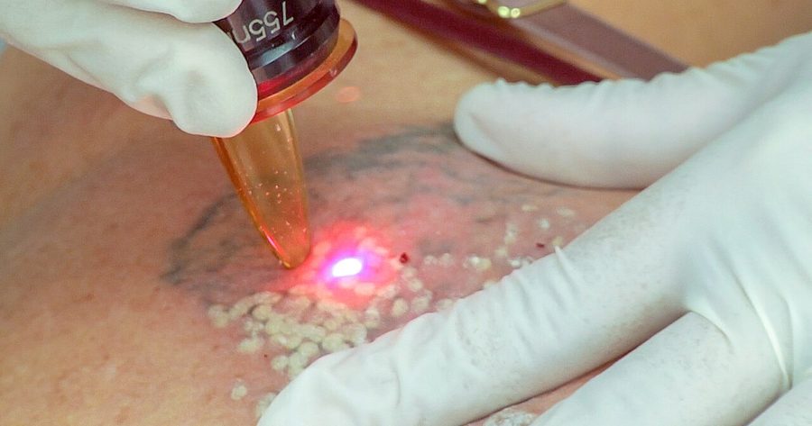 Tattoo removal costs about $353 per session in 2026