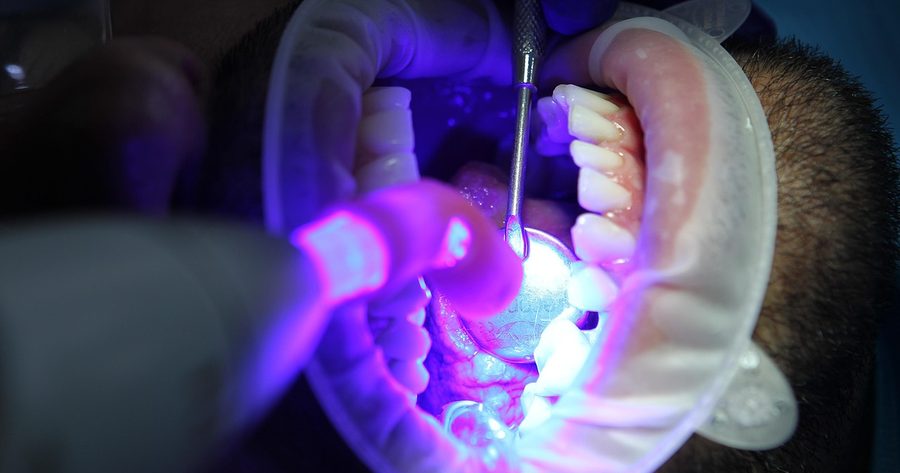 Professional teeth whitening costs $395 to $1,035 in 2026