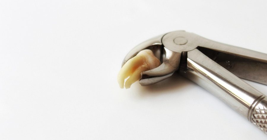 A simple tooth extraction costs $170 to $450 in 2026