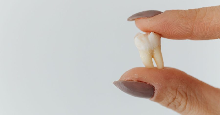 Wisdom teeth removal costs $400 to $1,055 in 2026